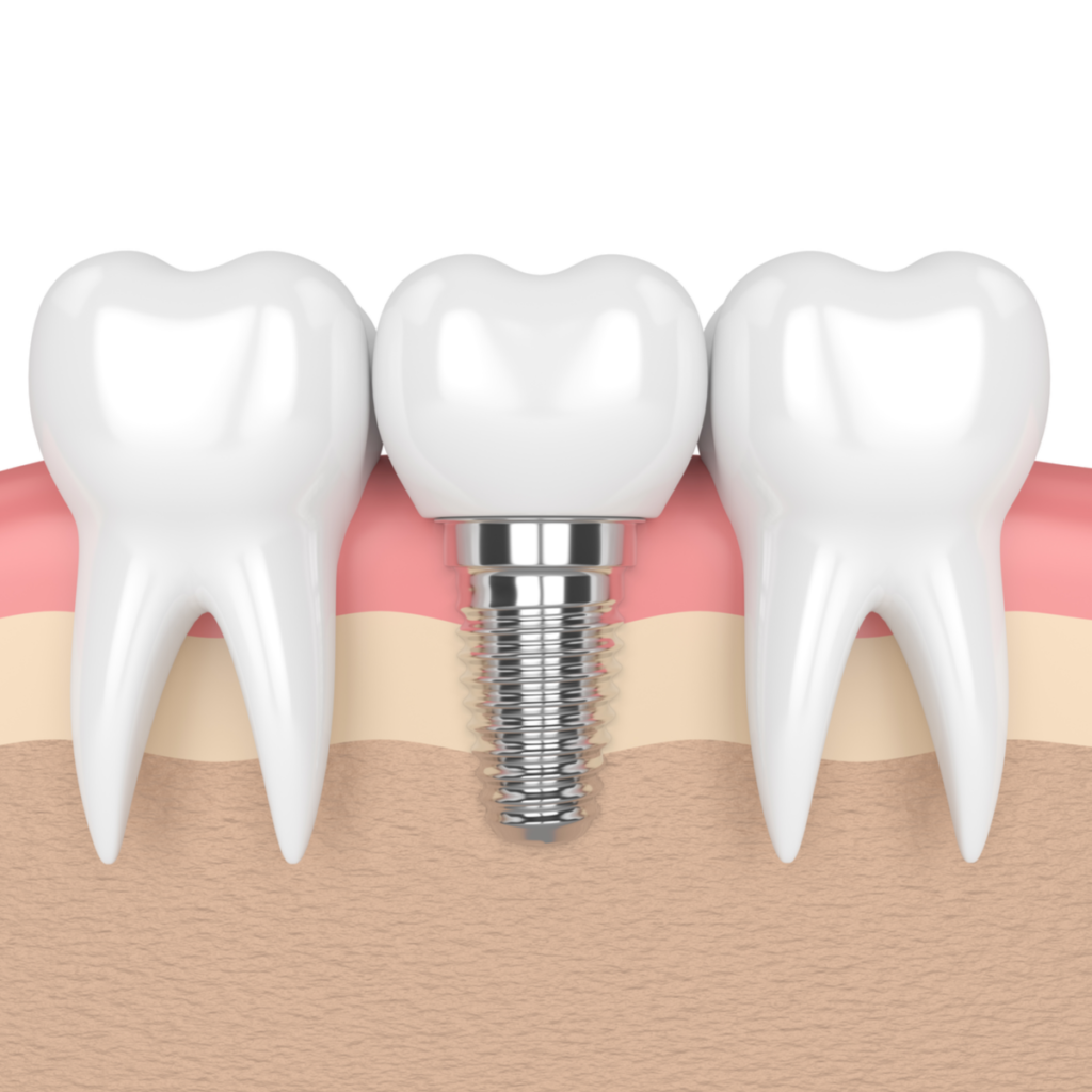 Dental Implants Miami Fl Right Care Dental