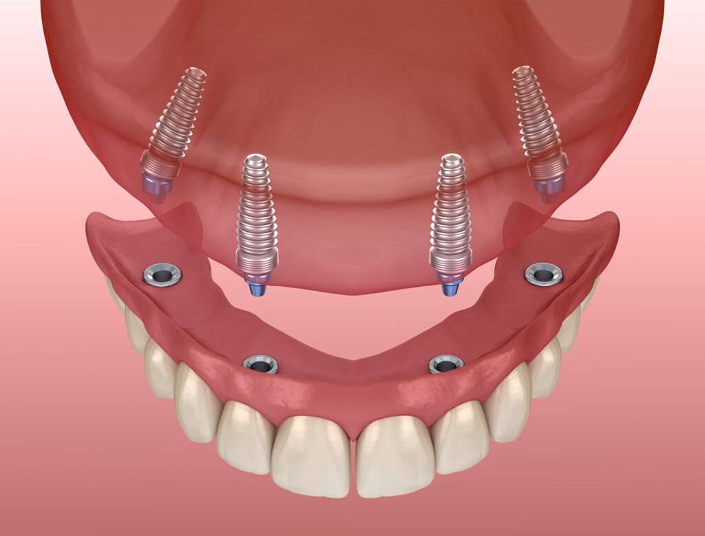Oral Surgery | Right Care Dental