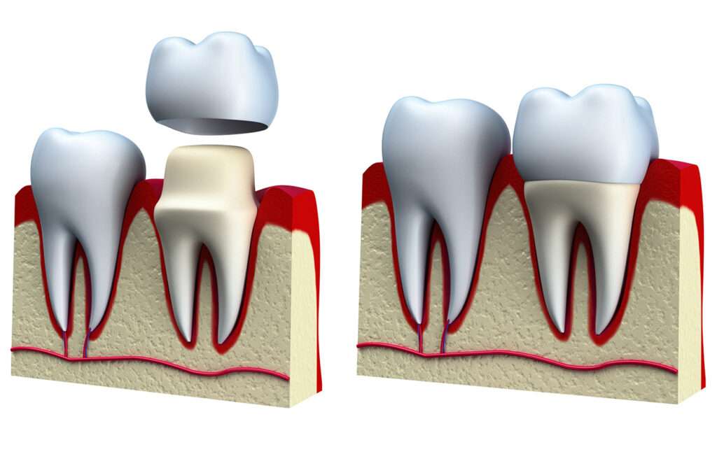 Dental Crowns