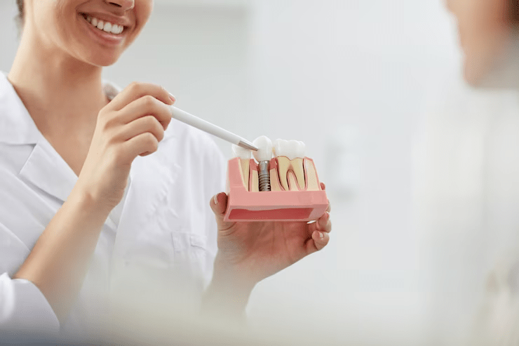 What to Know Before Getting Dental Implants? Important Facts