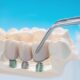 Enhance Your Look: Full Mouth Dental Implants Explained