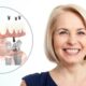 Achieve Lasting Results: Professional Dental Implants Miami