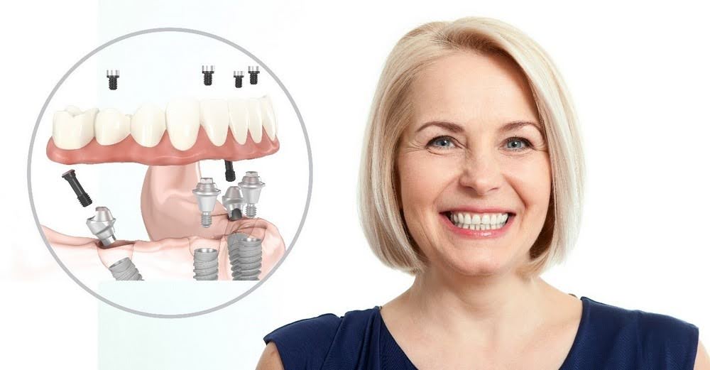 Patient receiving dental implants in a Miami clinic
