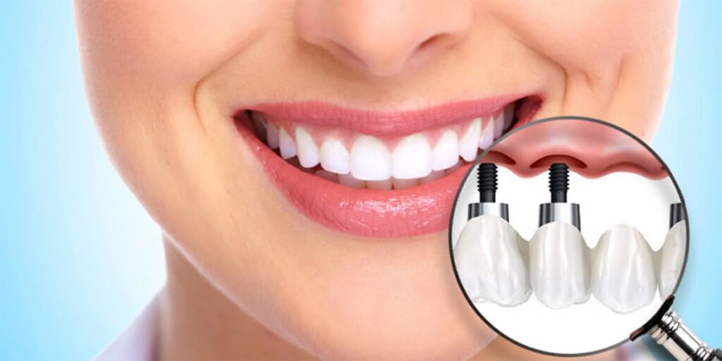 Dental implant procedure for tooth pain relief in Miami