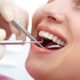 How Much Does a Filling Cost: What You need to know