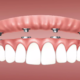 Why Miami Dental Implants Is The Best Option For You?