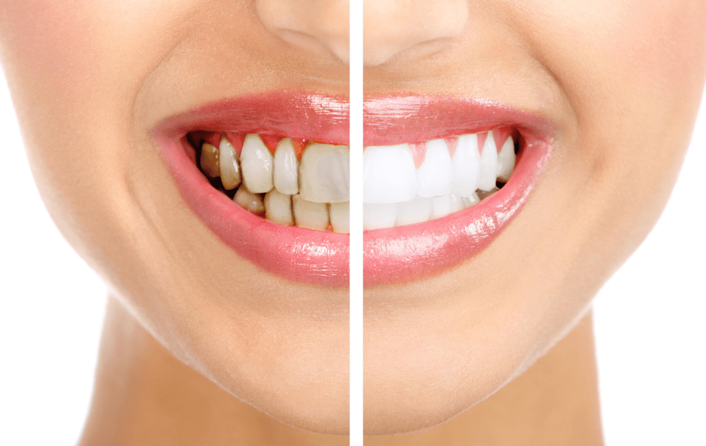 Simple Dental Care Hacks for Healthy Teeth and Gums