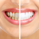 Easy Care Hacks For Perfect Teeth And Gums