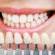Dental Filling Cost Trends: What’s New And What’s Changing?