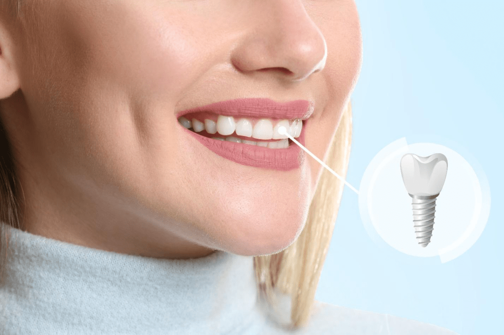 Revealing the 5 Life-Changing Benefits of Dental Implants in Miami