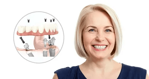 What Makes Affordable Dental Implants the Best Choice for You