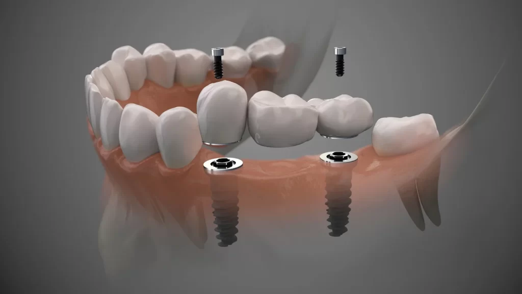 How to Find Affordable Dental Implants Without Sacrificing Quality