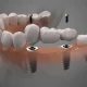 How to Find Affordable Dental Implants Without Sacrificing Quality