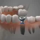 How Miami Athletes Can Benefit From Professional Dental Implants