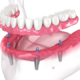 What You Need to Know Before Choosing All on 4 Implants