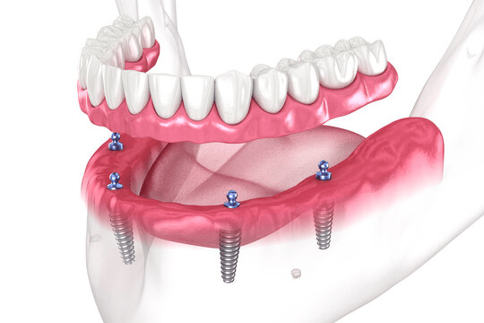 Guide to All on 4 Implants: Considerations Before Choosing