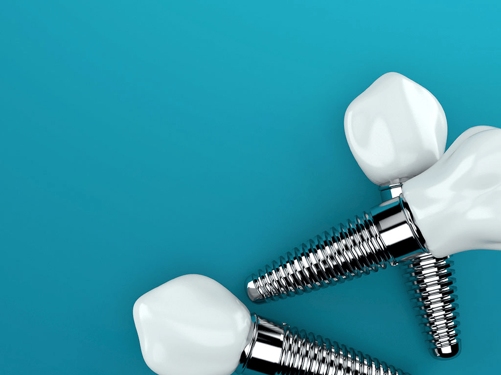 Can You Really Get Quality Dental Implants on a Budget?