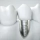 How Expats In Miami Can Benefit From Professional Dental Implants Miami