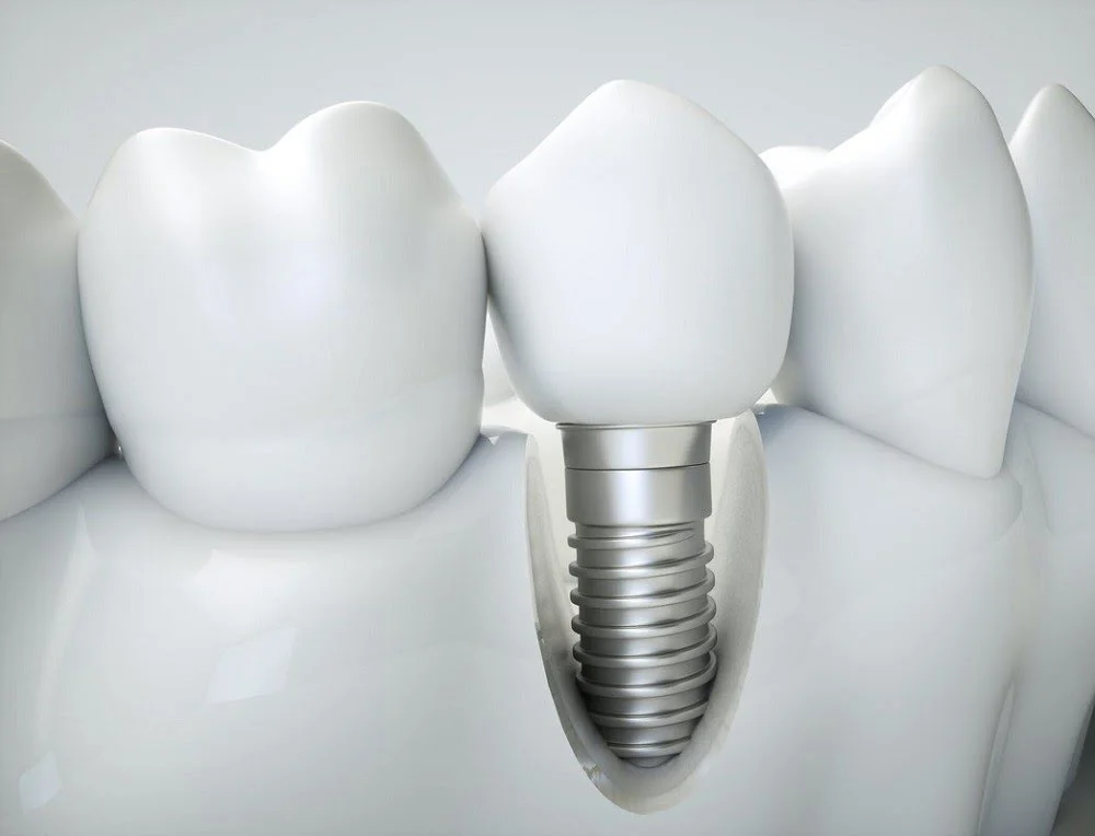 Professional Dental Implants in Miami: A Guide for Expats