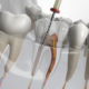 Top 3 Signs You Need a Root Canal in Miami: Don’t Wait Too Long