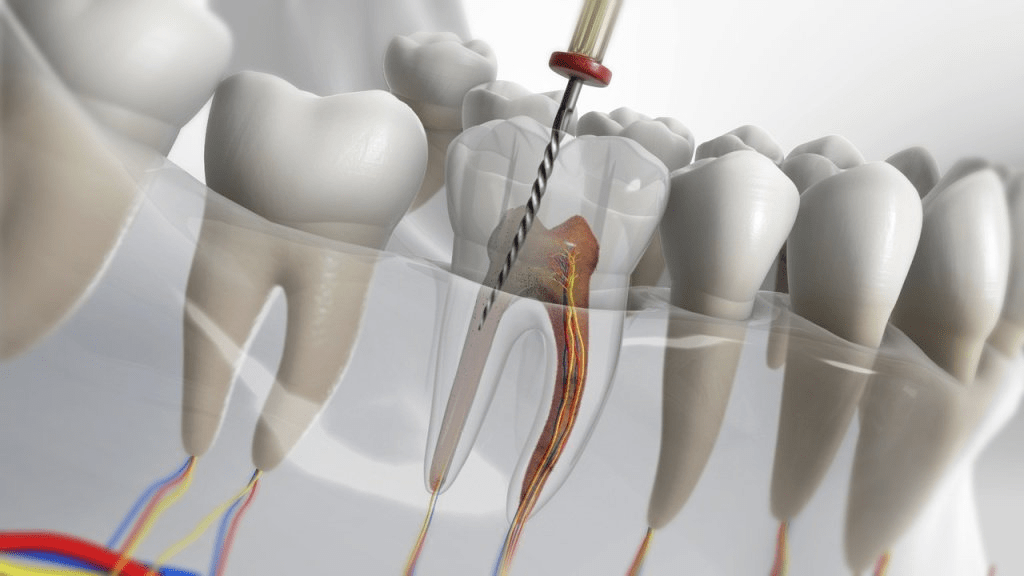 Top 3 Signs You Need a Root Canal in Miami: Don’t Wait Too Long